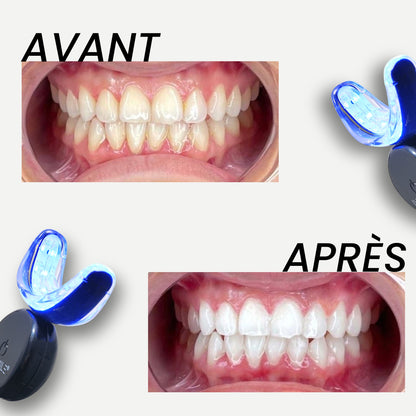 Kit de blanchiment dentaire LED