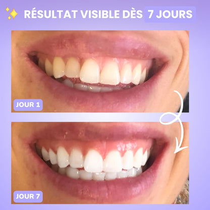 Kit de blanchiment dentaire LED